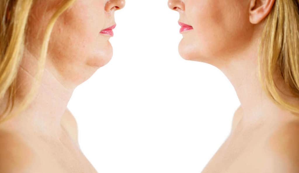 Double Chin treatment Redditch before and after results