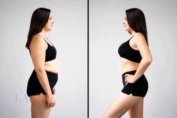 LA-EMS Body Sculpting Redditch results before and after of womans results on body toning.