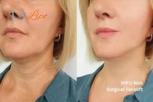 hi-fu for wrinkles Redditch before and after results