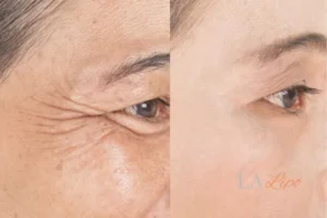 Before and after results of woman - HI-fu wrinkles reduction treatment Redditch