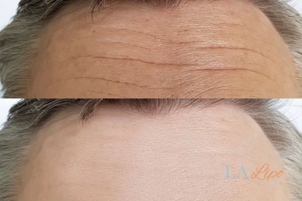 results of HIFU Redditch on mans forehead to help reduce lines and wrinkles