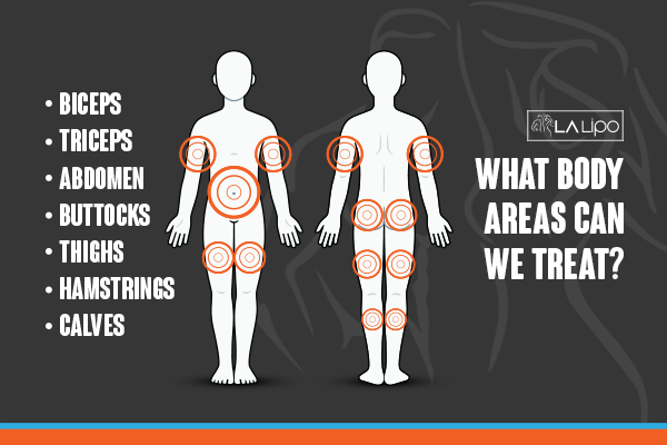 Graphic to show areas you can have LA-EMS Body Sculpting Redditch treatment.