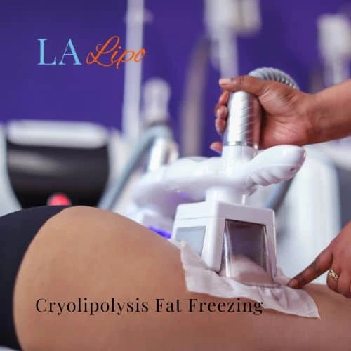 fat freezing - Cryolipolysis Redditch