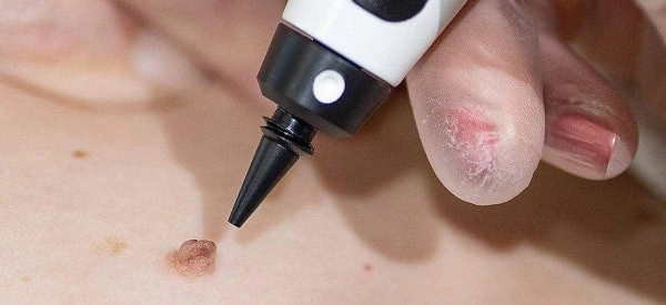 skin tag removal using cryopen Redditch