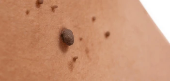 image of a skin tag Redditch