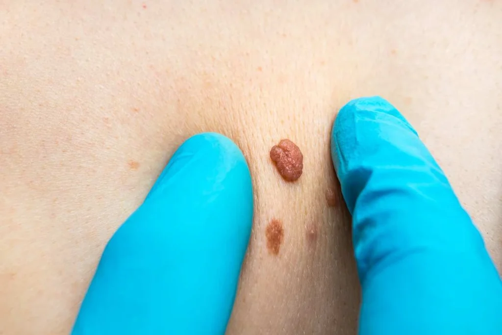 Consultant examining a skin tag Redditch