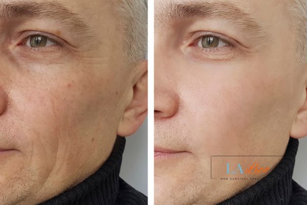 See the amazing results of Morpheus8 Treatment Redditch!