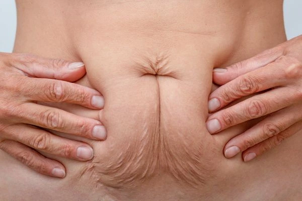 Should I Combine Diastasis Recti Treatment with Body Contouring for Better Results Redditch?