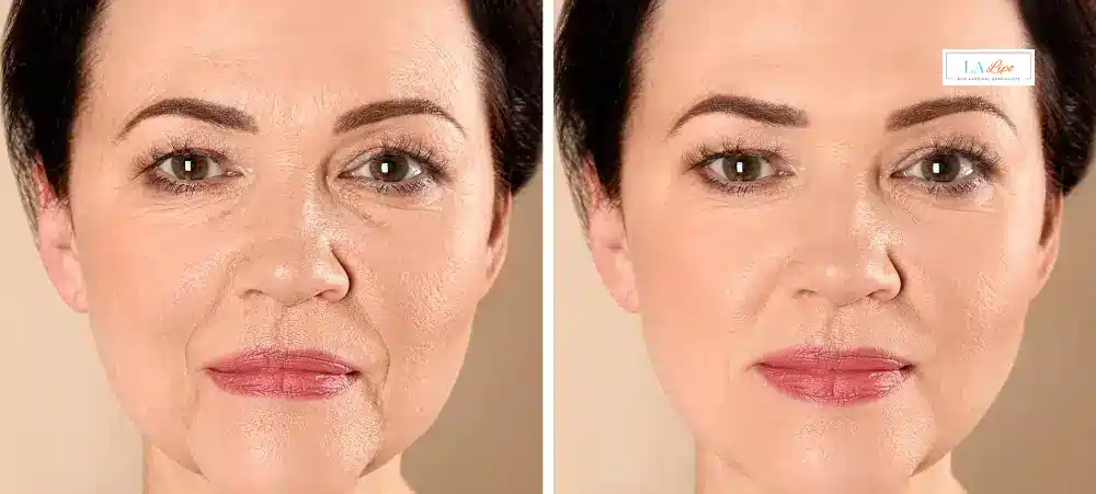 How Long Does It Take to See Results and How Long Do They Last Redditch?